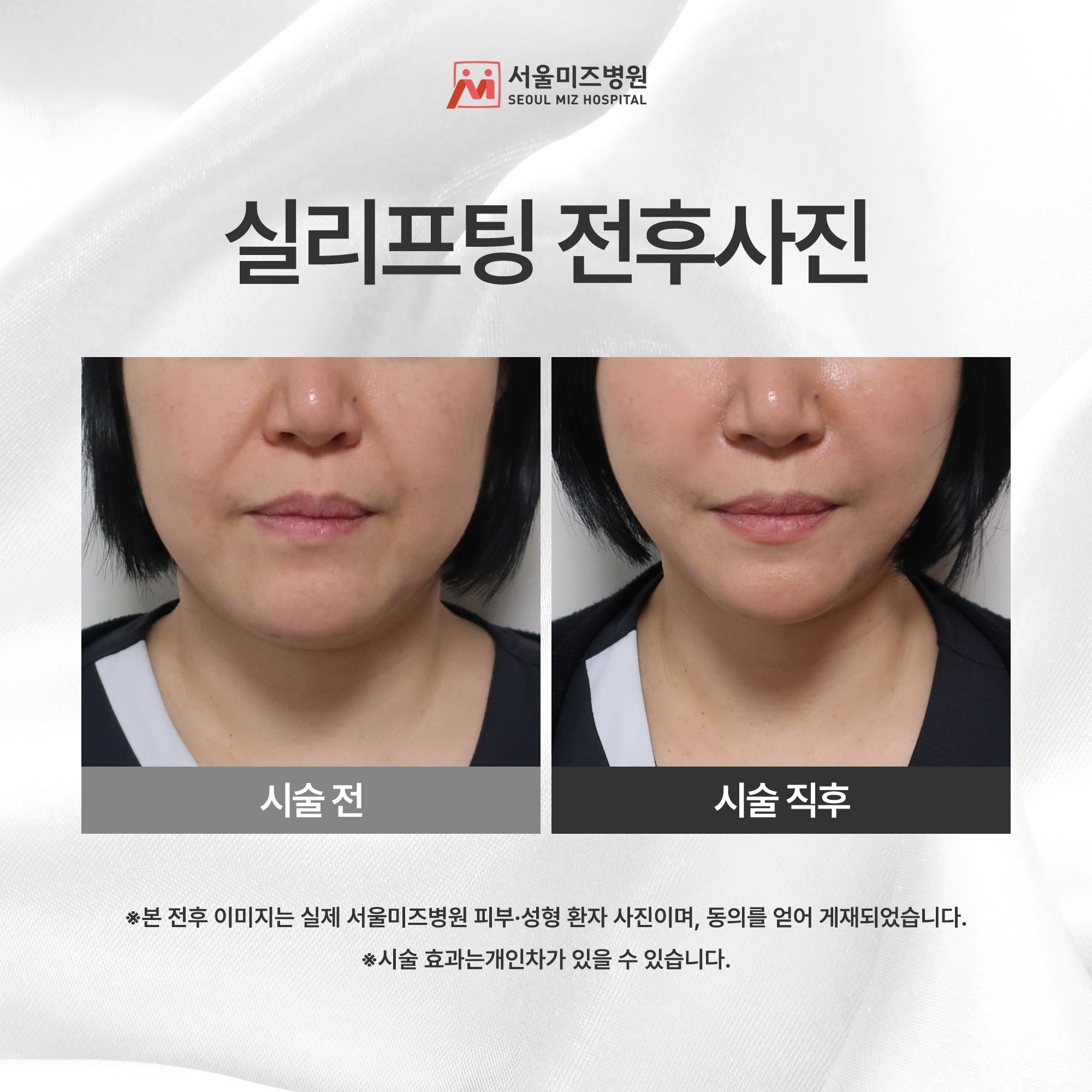 실리프팅 전후사진