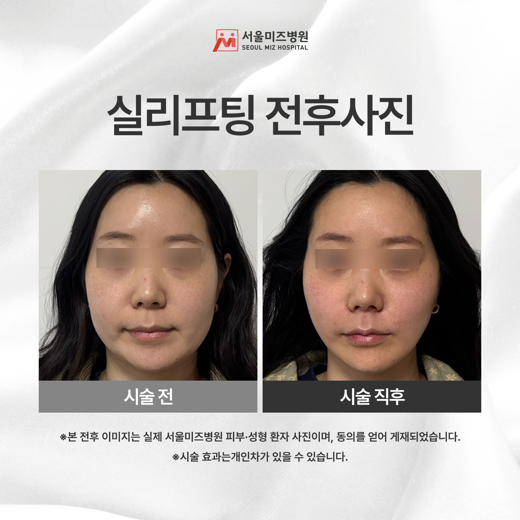 실리프팅 전후사진